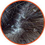 Dry Scalp Dandruff